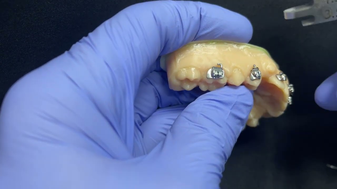 Bracket placement protocol for Class II, Div 2