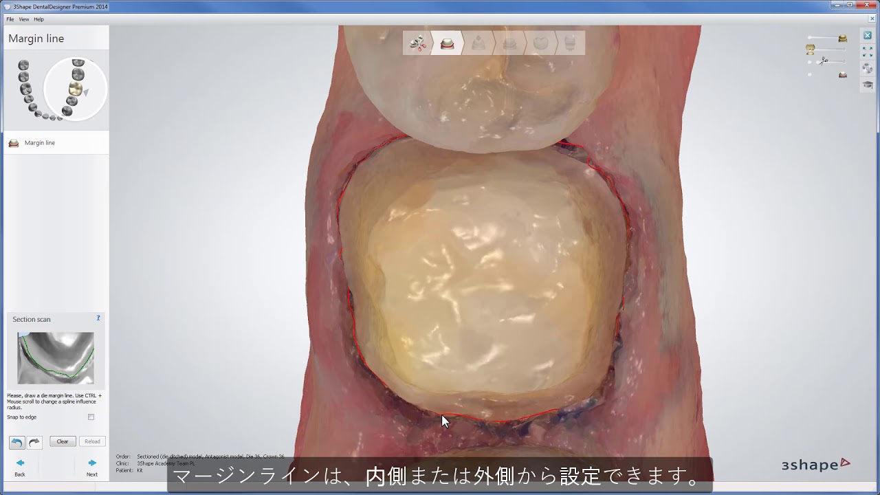 3Shape Dental System - TRIOS スキャンからのフルアナトミカルクラウン