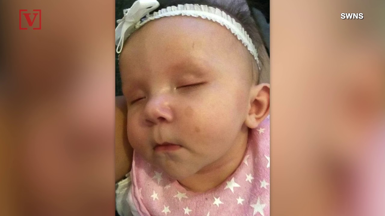 Harmless-Looking ‘Freckles’ Lead to Baby Diagnosed With Rare Tumor-Causing Disease