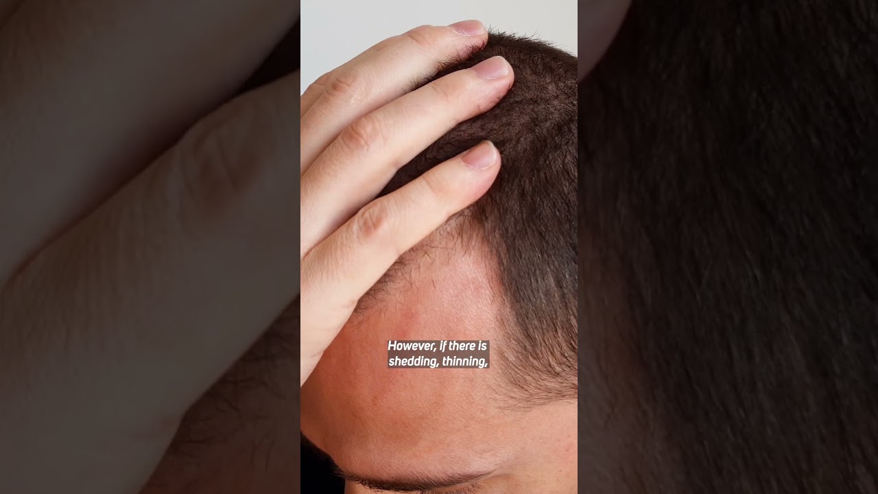 Sa&ccedil; Ektirmek Mi PRP Mi? - Hair Translpant or PRP?