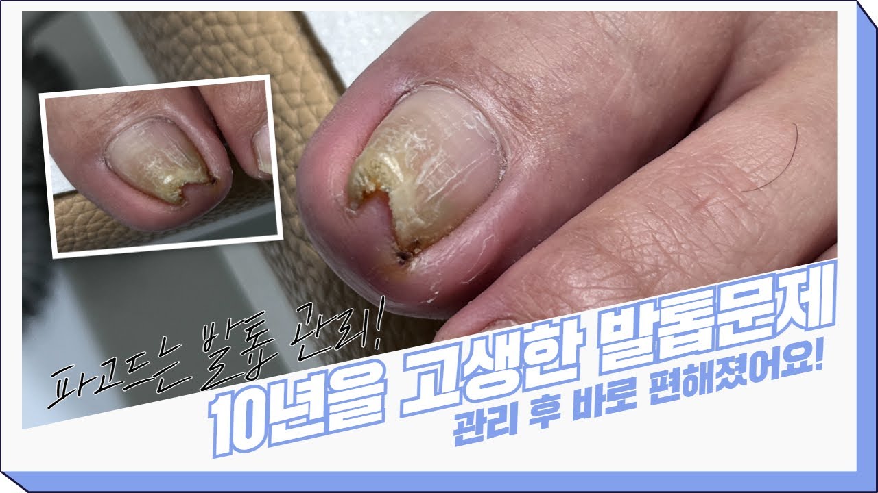 10년을 고민한 발톱 문제..! 드디어 편안해졌습니다