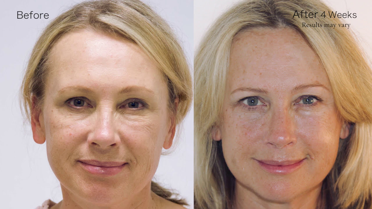 BEVERLY HILLS MD LIFT & FIRM TESTIMONIAL: JENNIFER