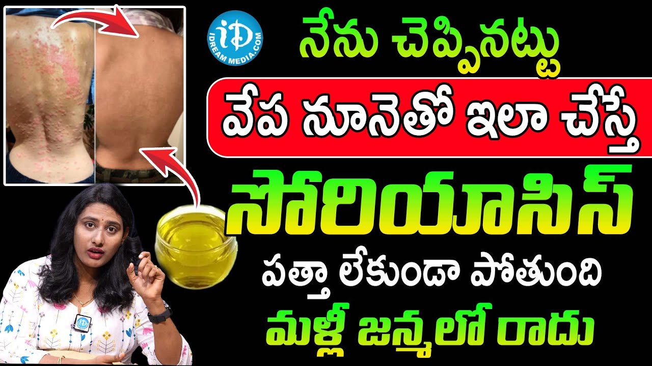 ఇలా చేస్తే సోరియాసిస్ మటుమాయం | Psoriasis Treatment in Telugu | Anu Chowdary | iDream Health Talks