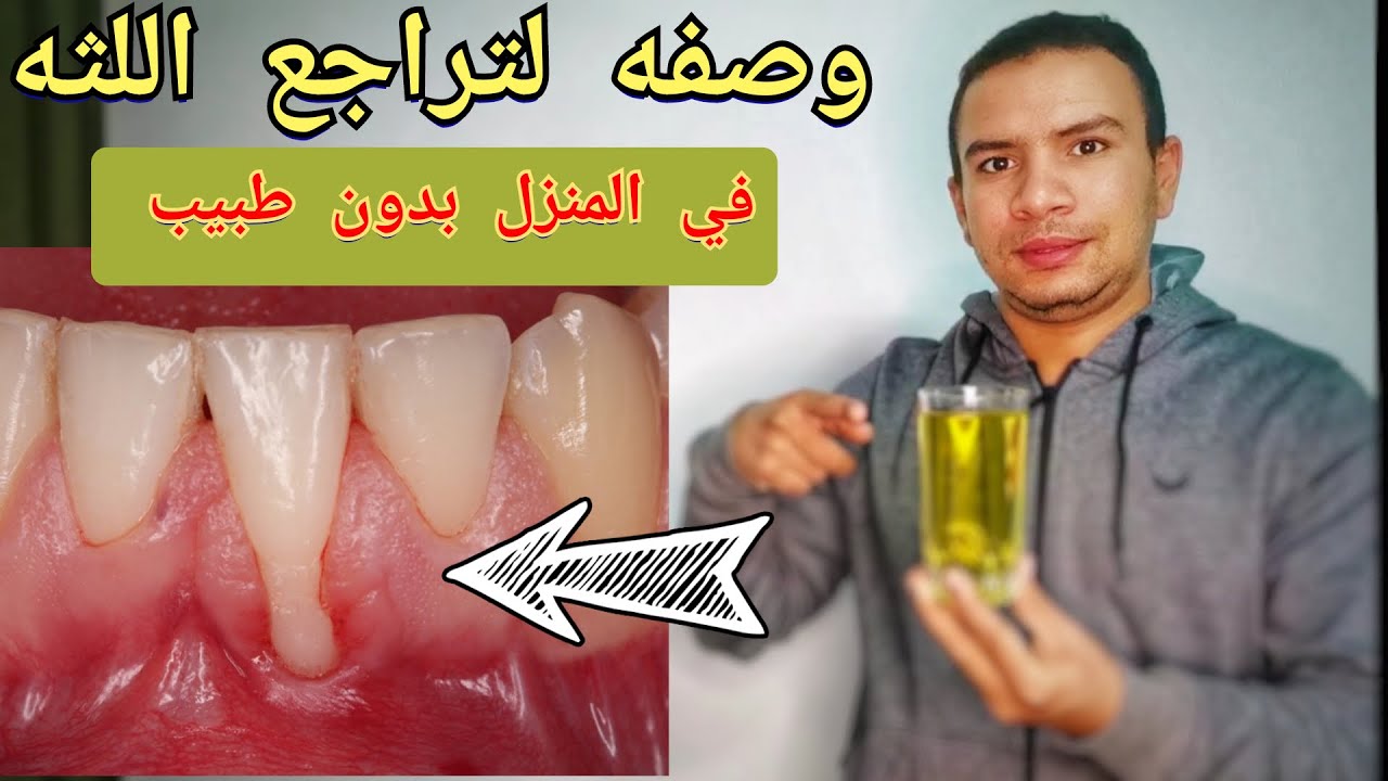 افضل وصفه لتراجع اللثه - ٦ وصفات تخلصك من تراجع اللثه - عالج تراجع اللثه دون رجعه