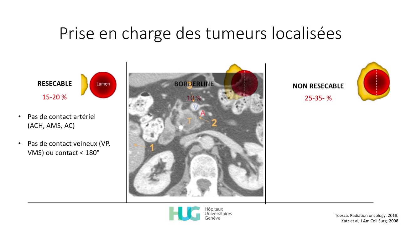 Cancer du pancréas : le tueur est toujours en liberté - Dr T. Kössler