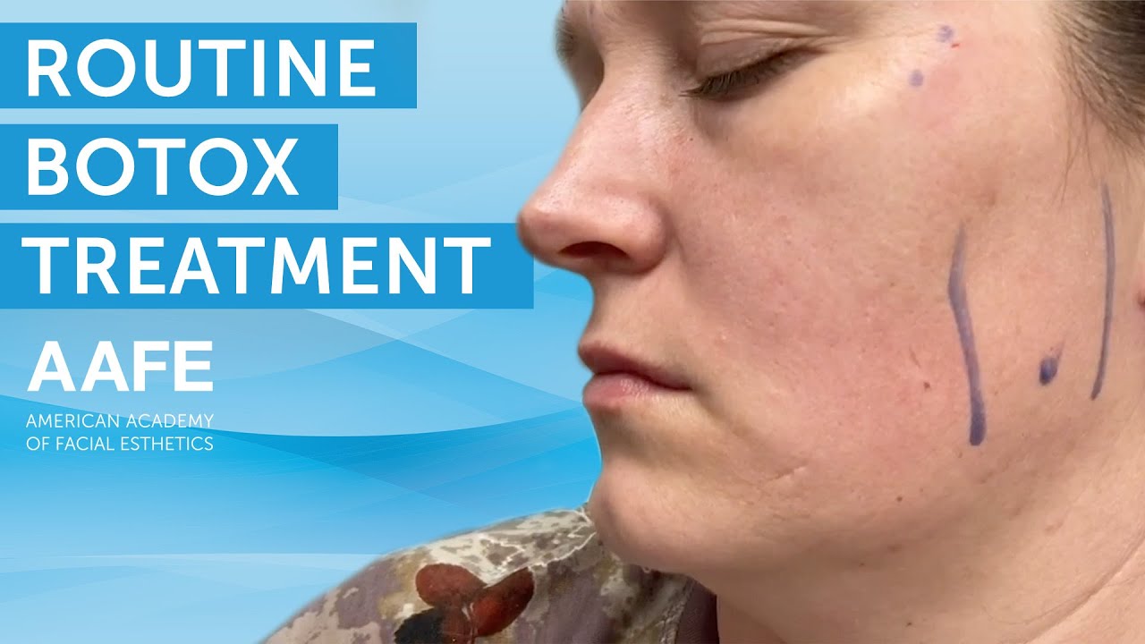 Routine Botox Treatment | AAFE