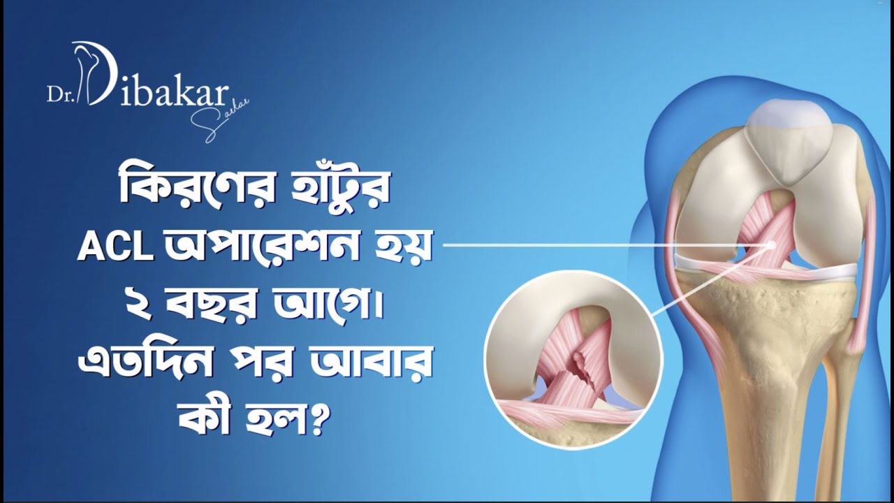 কিরণের হাঁটুর ACL অপারেশন হয় ২ বছর আগে। এতদিন পর আবার কী হল?