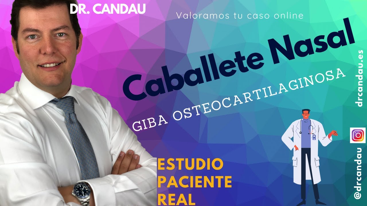 Rinoplastia Ultrasónica Ambulatoria - Manejo de gibas osteocartilaginosas
