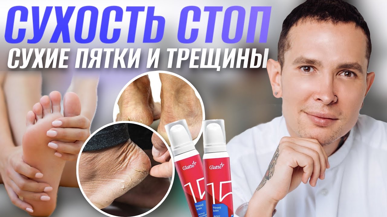 Сухость стоп и трещины | Причины и предотвращение | Самый эффективный способ лечения