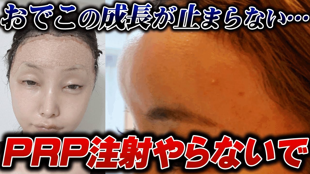 【PRP注射の数年後の危険性について】おでこを丸くしたら最悪な結果になりました…
