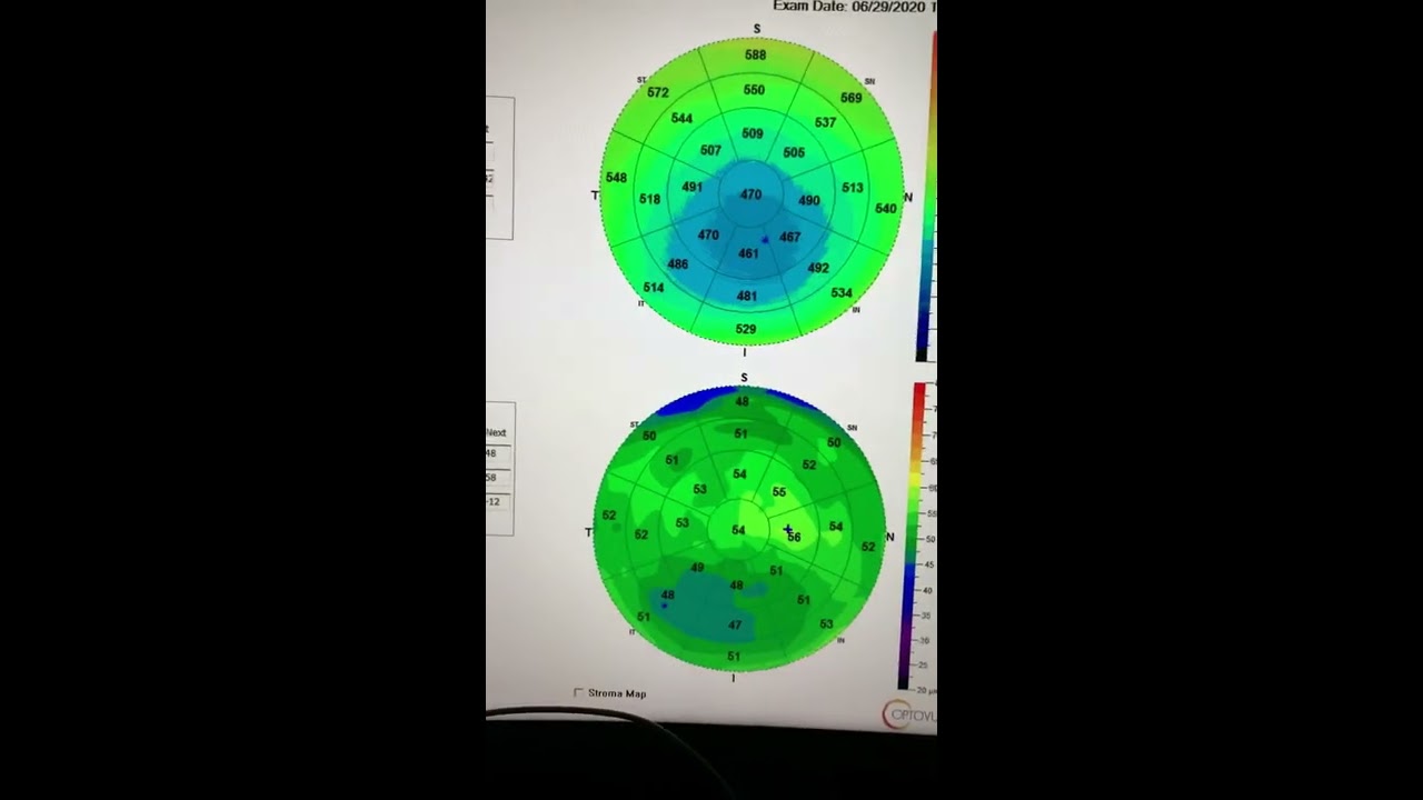 36yo pilot keratoconus progression despite stopping eye rubbing