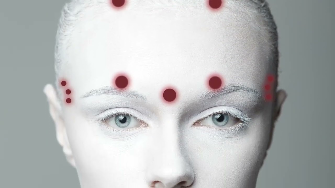 Botox Injections for Migraine Treatment