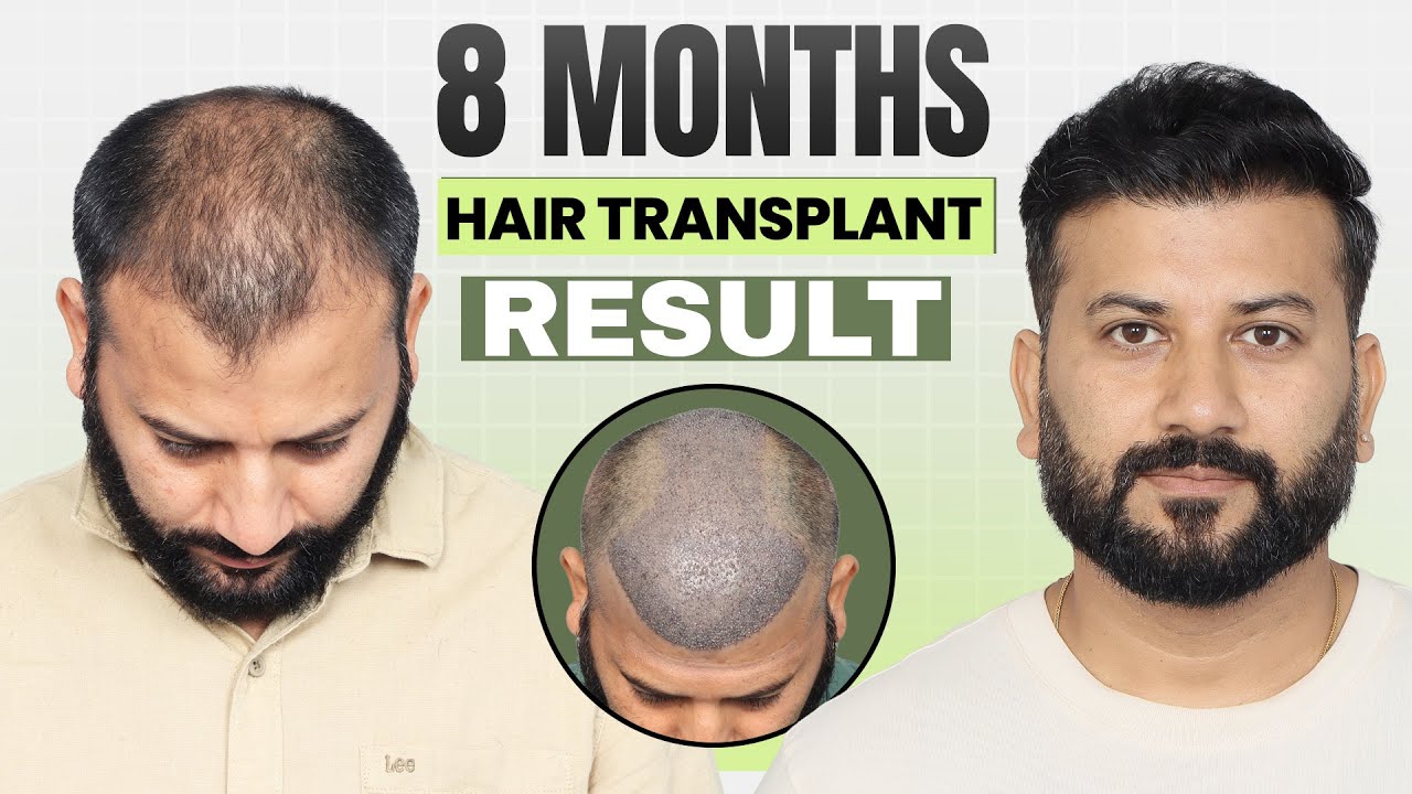 Hair Transplant in Ranchi  | Best Results & Cost of Hair Transplant in Ranchi