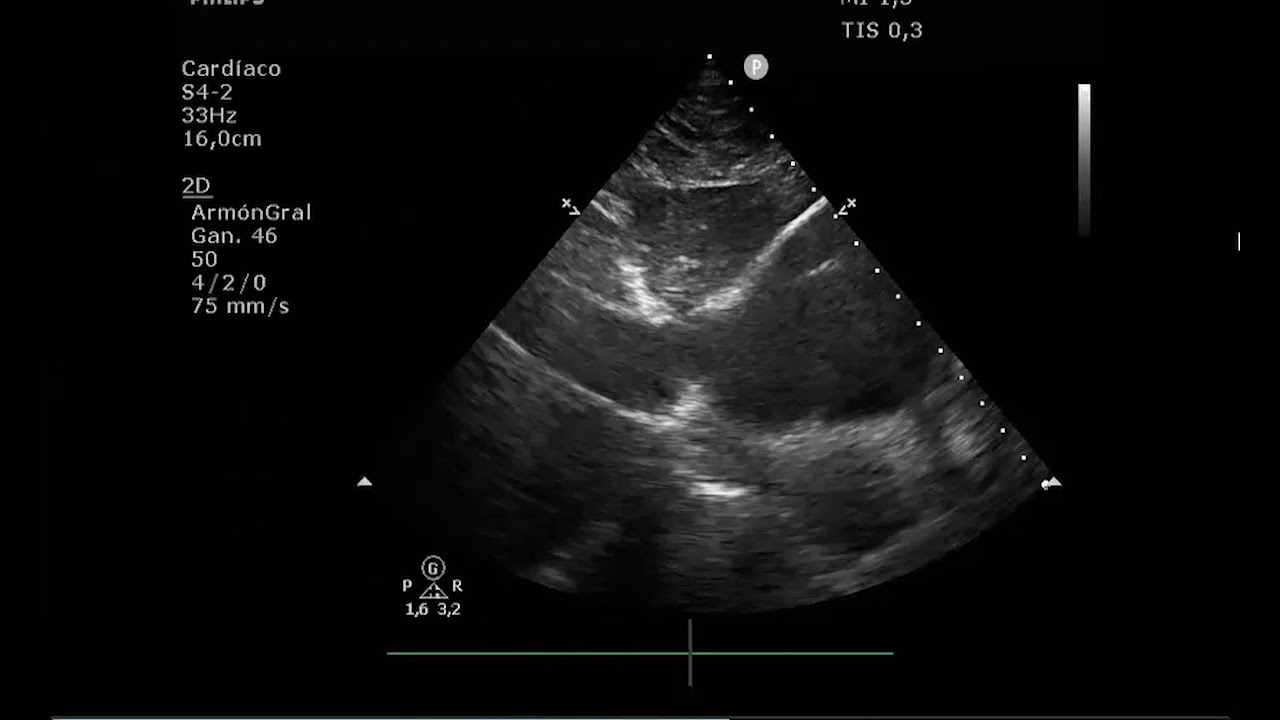 Ateneo IMedCV - Insuficiencia mitral secundaria - Dr. Gonzalo Fernandez