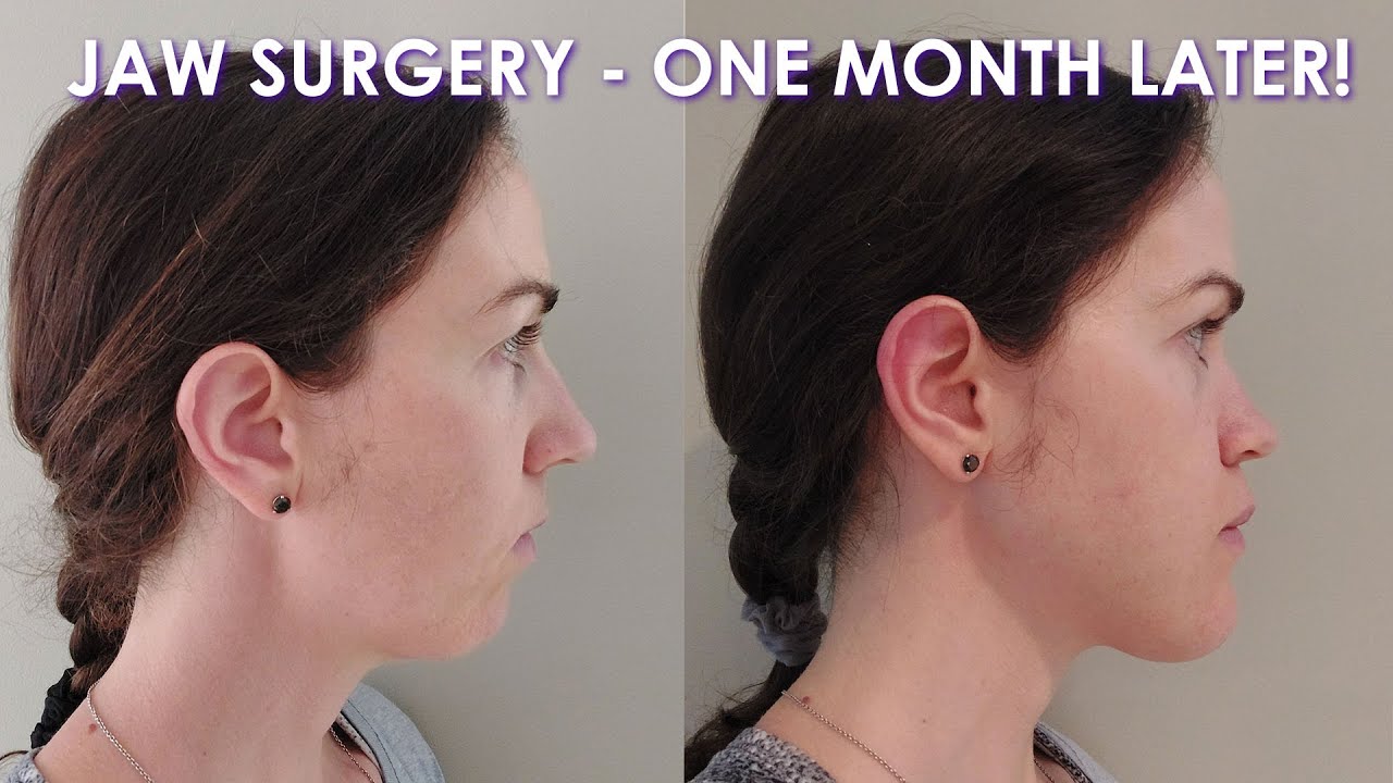 DOUBLE JAW SURGERY: ONE MONTH LATER (This is harder than I thought...)