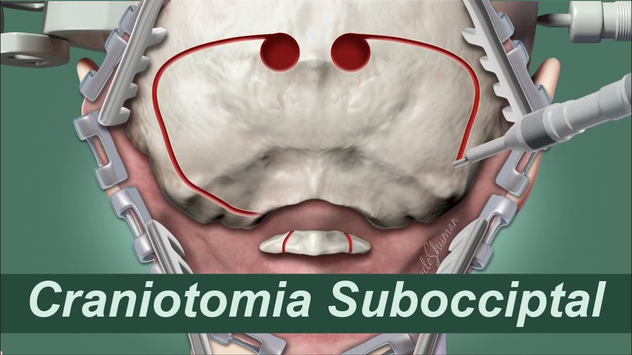Anima&ccedil;&atilde;o de Craniotomia Subocciptal para extra&ccedil;&atilde;o de tumores da fossa posterior. Neurocirurgia