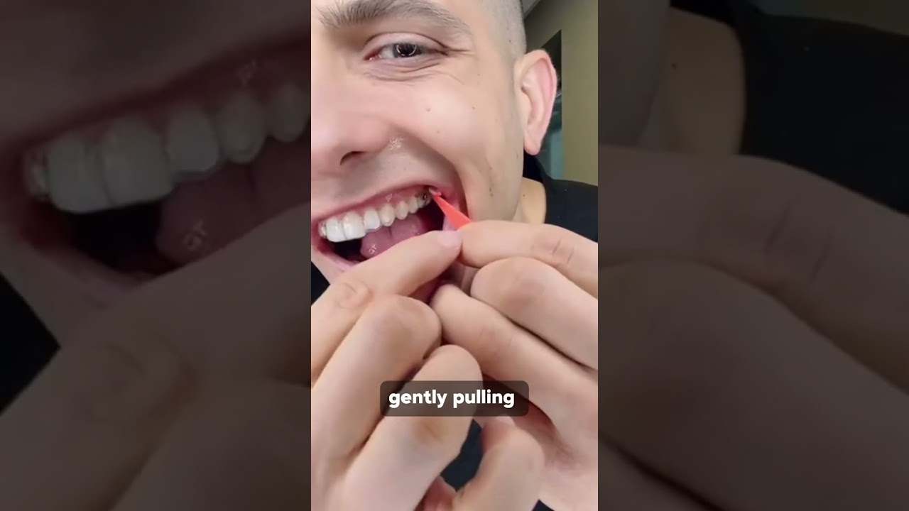How to Use Rubber Bands with Invisalign (Step-by-Step Tutorial)