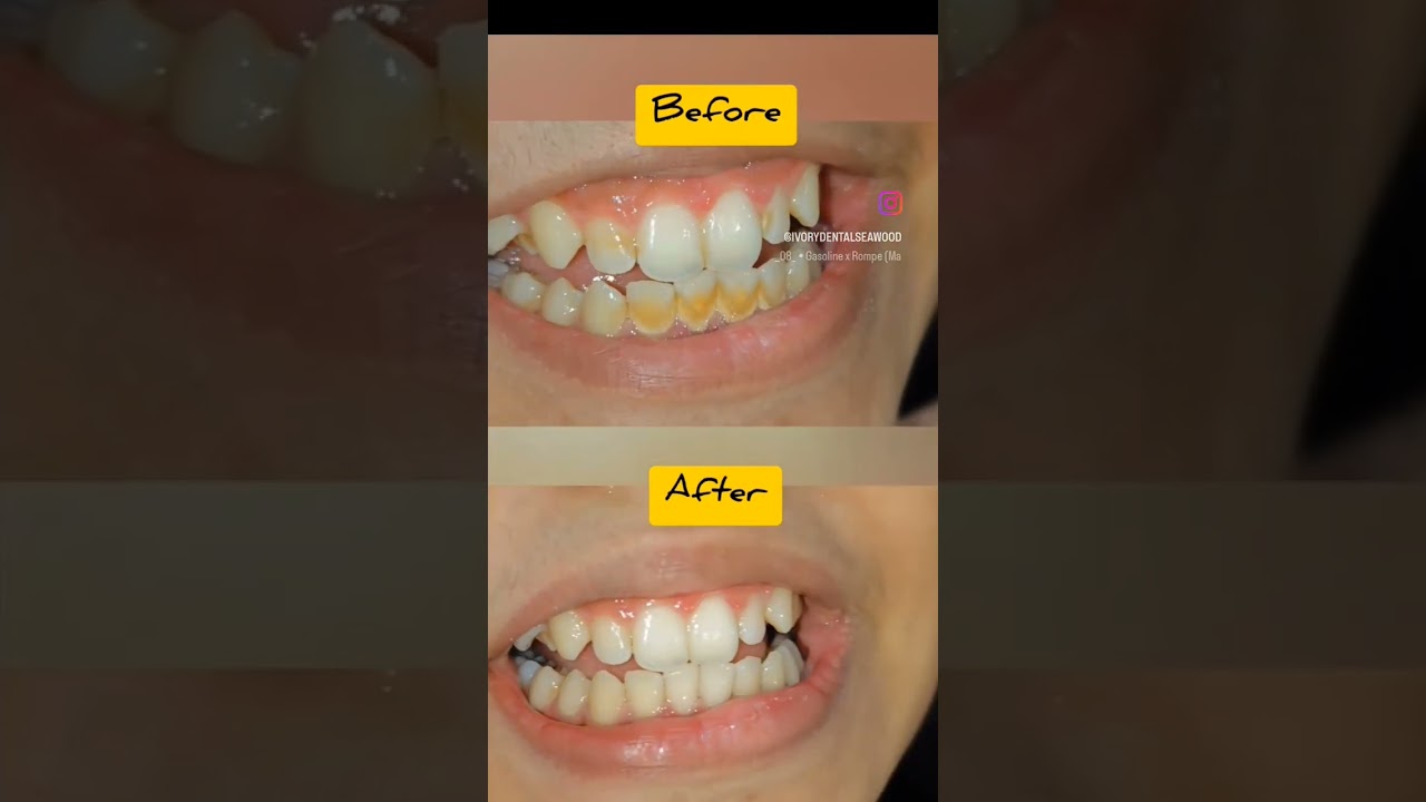 Tooth cleaning for a brighter smile 😁🦷🦷 #dentistry #dentalcare #oralcare #oralhealth #teeth #smile
