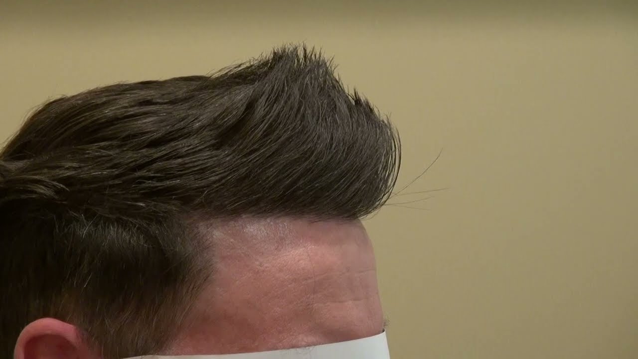 HAIR FULLY RESTORED! Hair Transplant Results- Hairline Lowering for Men | Forehead Reduction Surgery