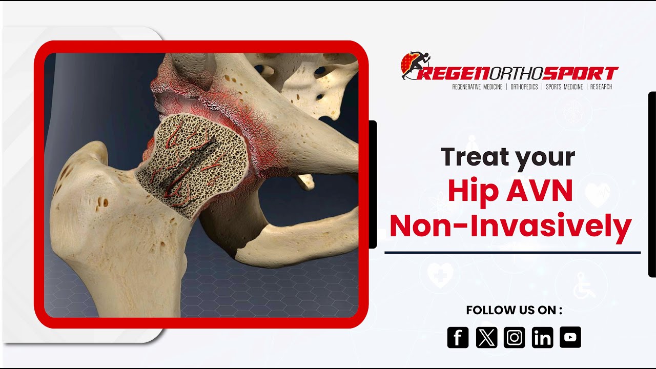 Avascular Necrosis, a Disease That Kills the Bone Tissue in the Hip Joint | RegenOrthoSport
