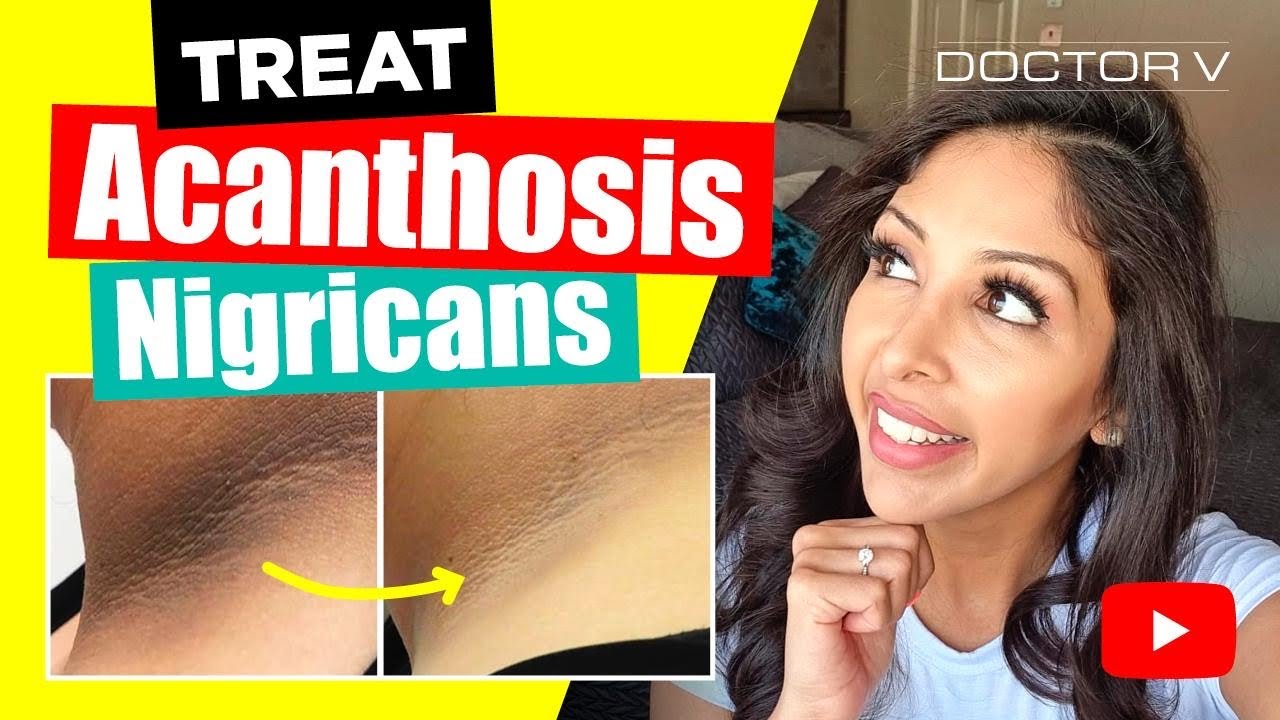 Doctor V - How To Treat Acanthosis Nigrican | Skin Of Colour | Brown Or Black Skin