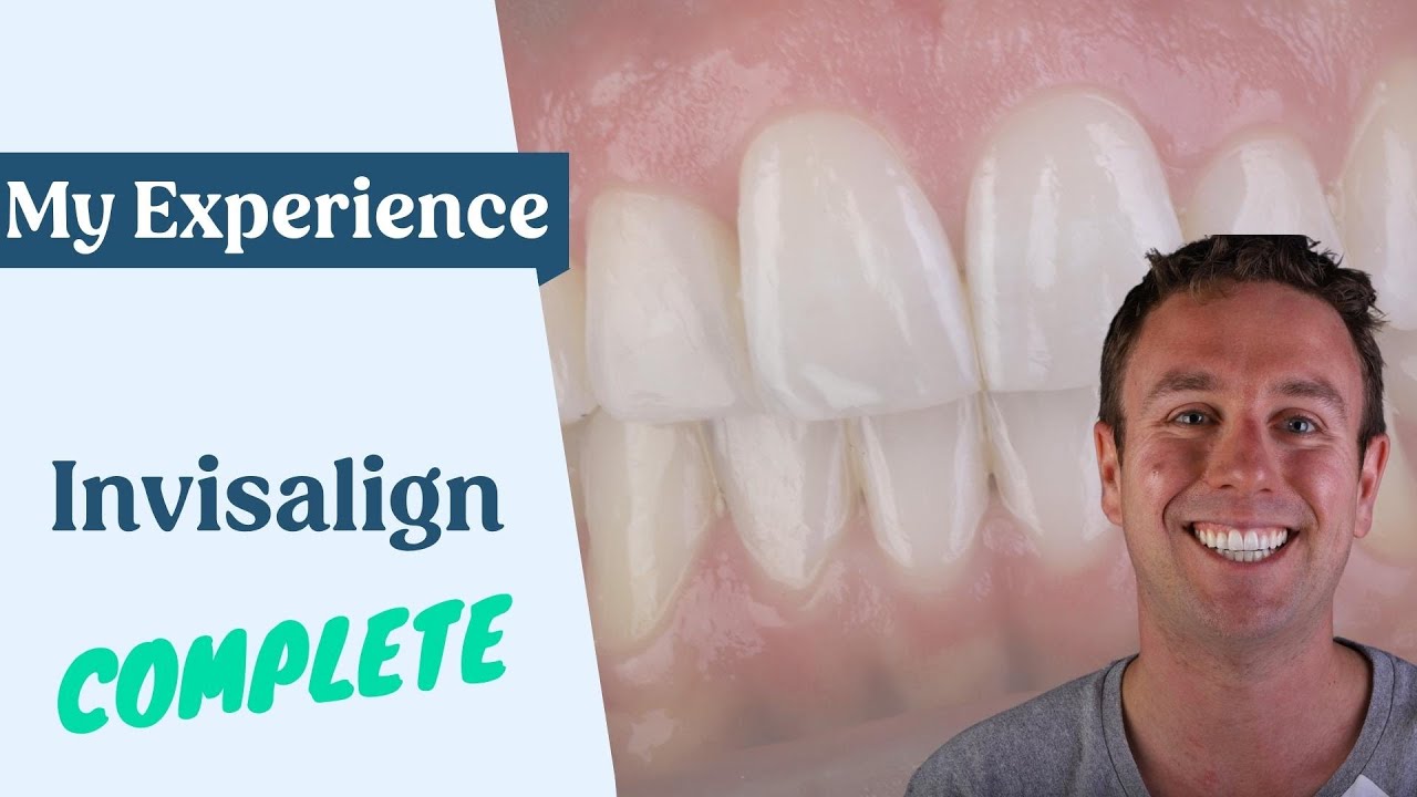 My Invisalign Experience Part 6 - Finally complete!