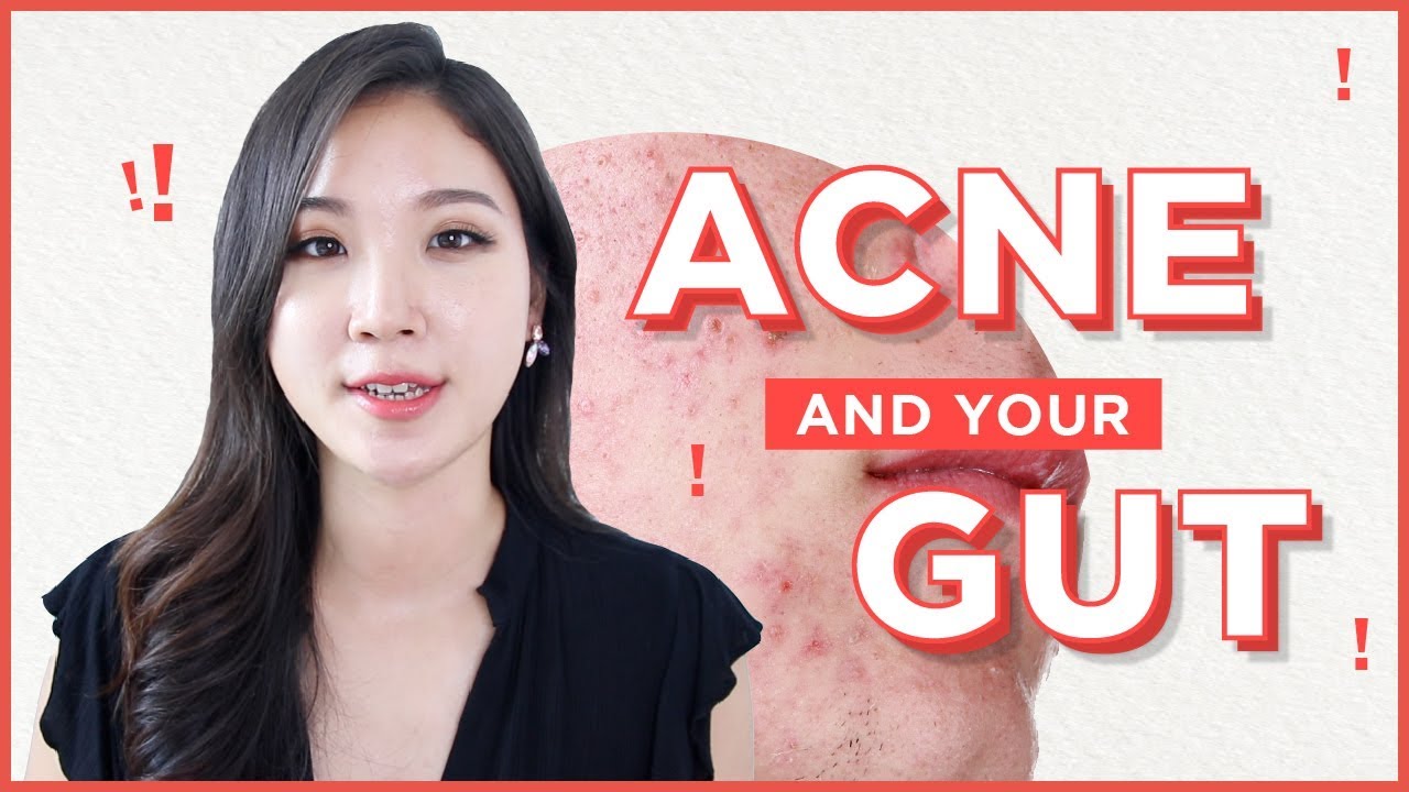 💩How To Treat Acne from the Inside Out • Acne and Gut health