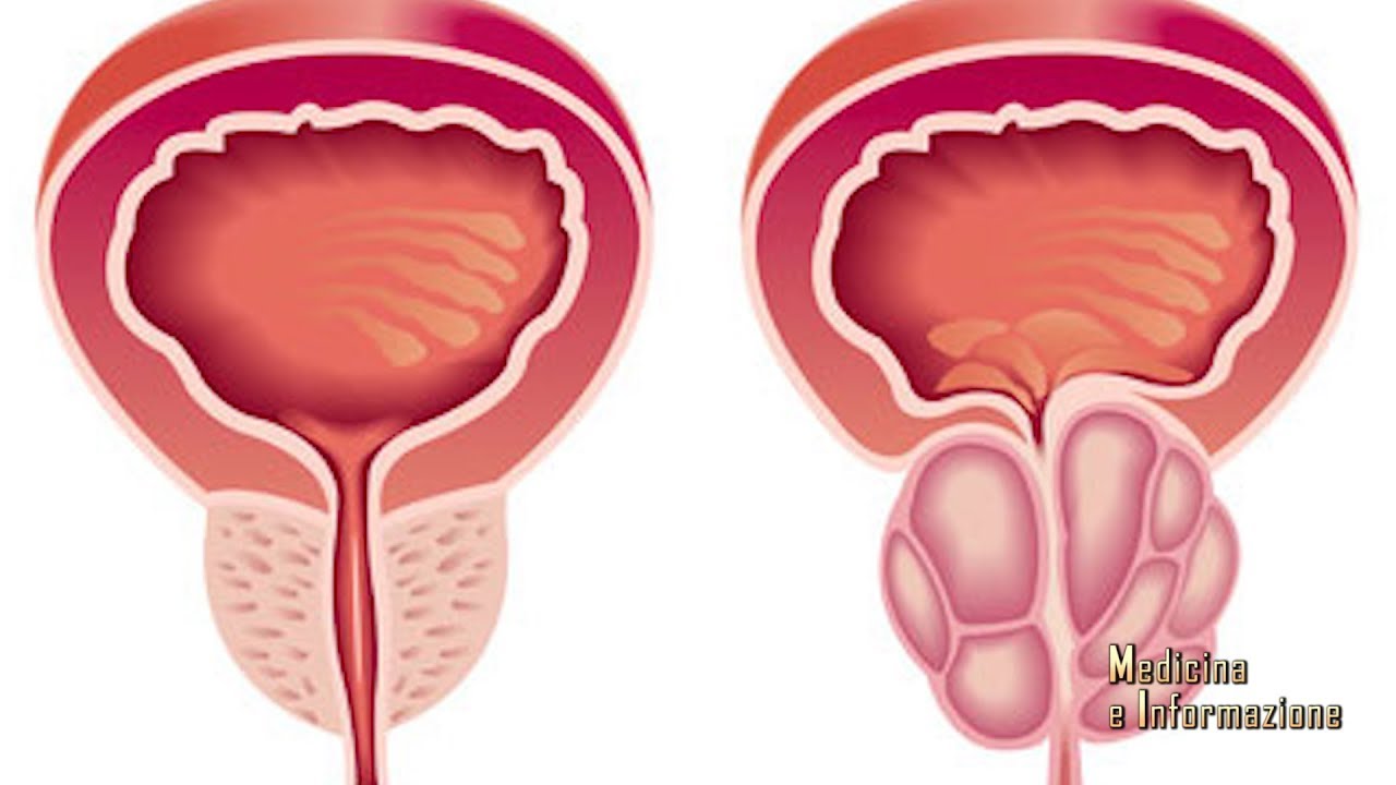 Ipertrofia Prostatica Benigna: i controlli, il trattamento