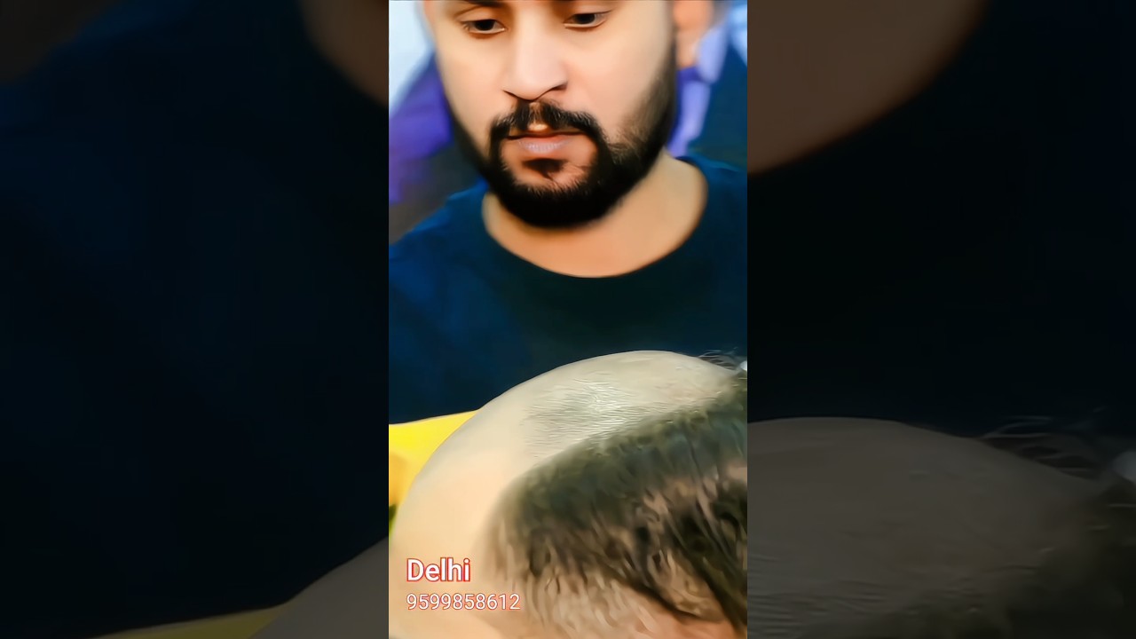 Best Hair Patch For Men | Hair Patch centre | 9599858612 #haircut #hairstyle #hairtransformation