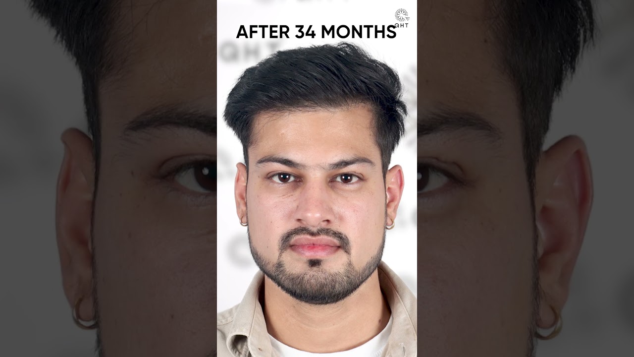 34 Months Hair Transplant Result #hairstyle #hairtransplant #viralvideo #shorts #explorepage