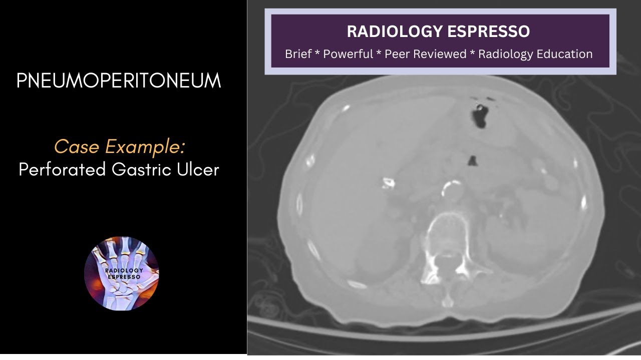 PNEUMOPERITONEUM: Case Example &ndash; Pneumoperitoneum on CT, Perforated Gastric Ulcer