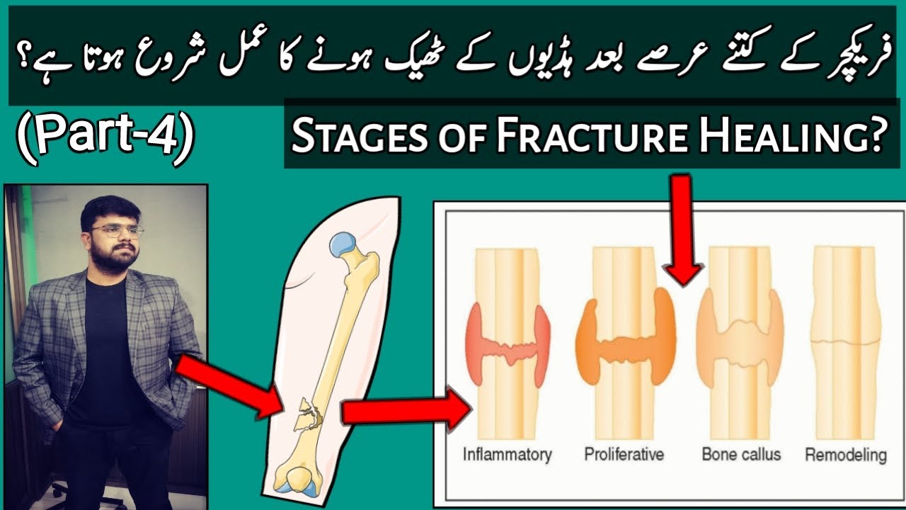 What are the 5 Stages Of Fracture Healing? || کتنی دیر بعد ہڈی کا فریکچر ٹھیک ہونا شروع ہوتا ہے؟