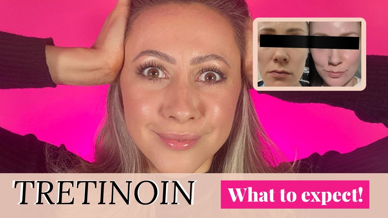 TRETINOIN BEFORE AND AFTER! Is Tretinoin Treatment Right For You?