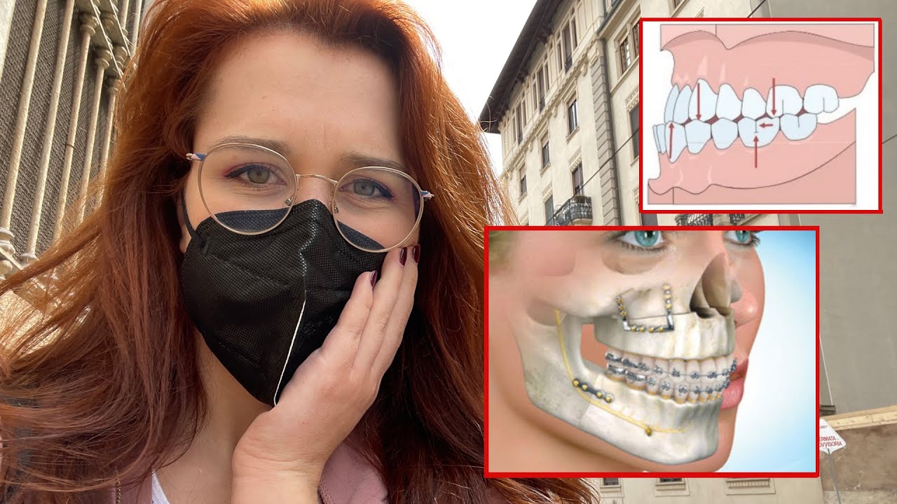 MI DEVO OPERARE?! 😳 *Malocclusione di III classe* | Arileigheas