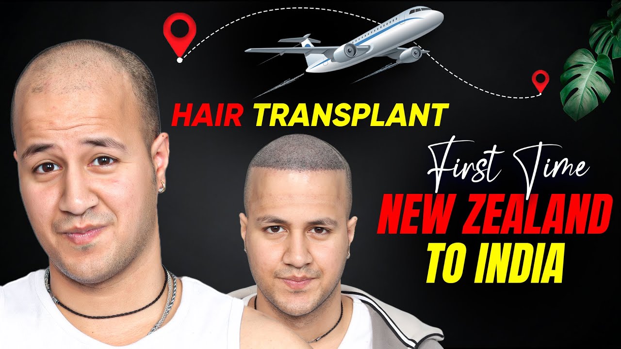 Hair Transplant in Hyderabad (HX-ZRUP) | Best Results & Cost of Hair Transplant in Hyderabad