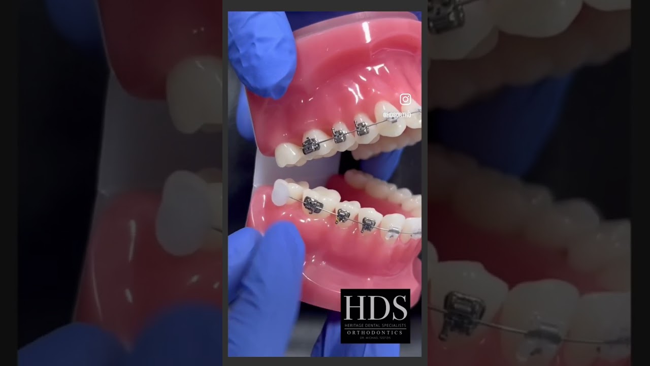 How to Use Orthodontic Wax