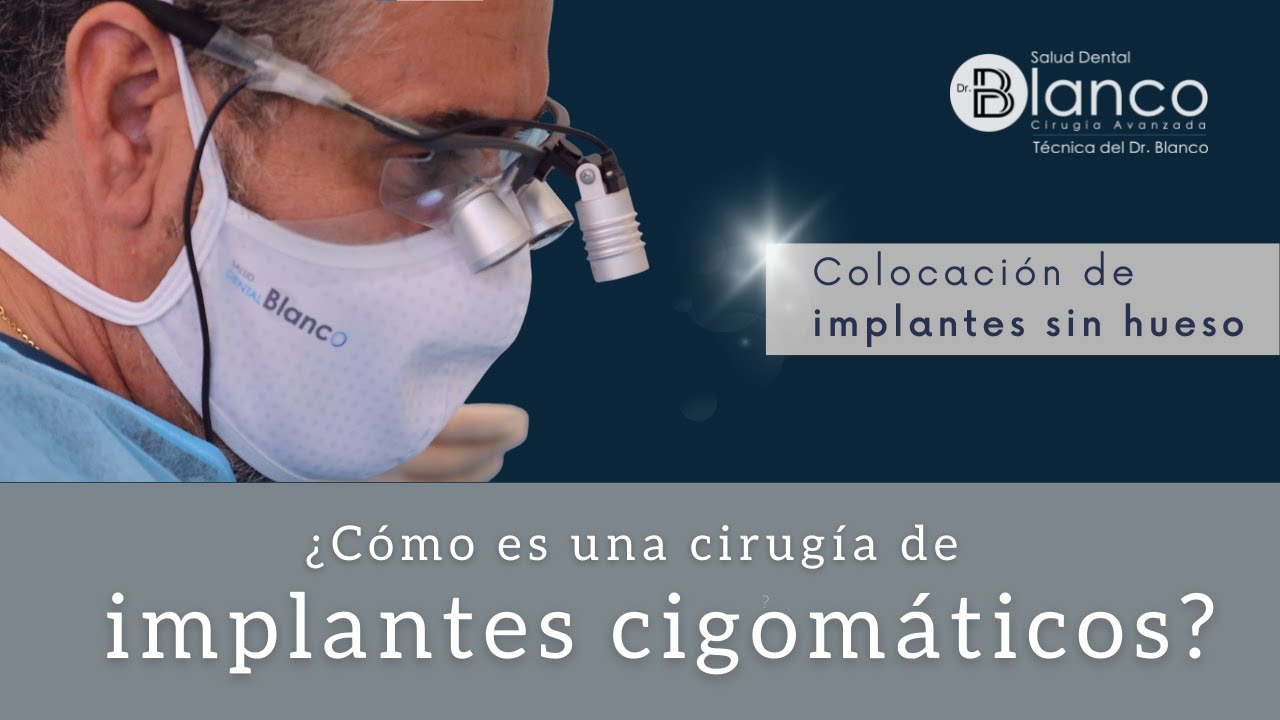 ¿Cómo es una CIRUGÍA DE IMPLANTES CIGOMÁTICOS? ✅