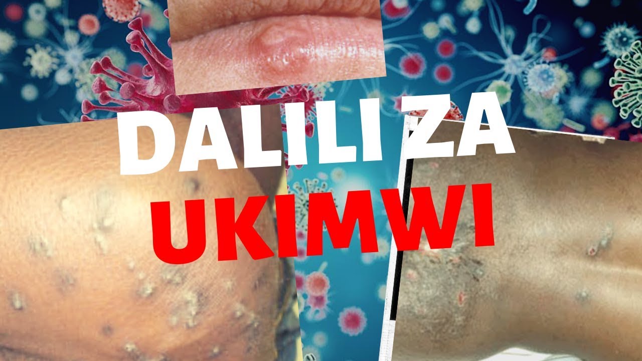 DALILI ZA UKIMWI