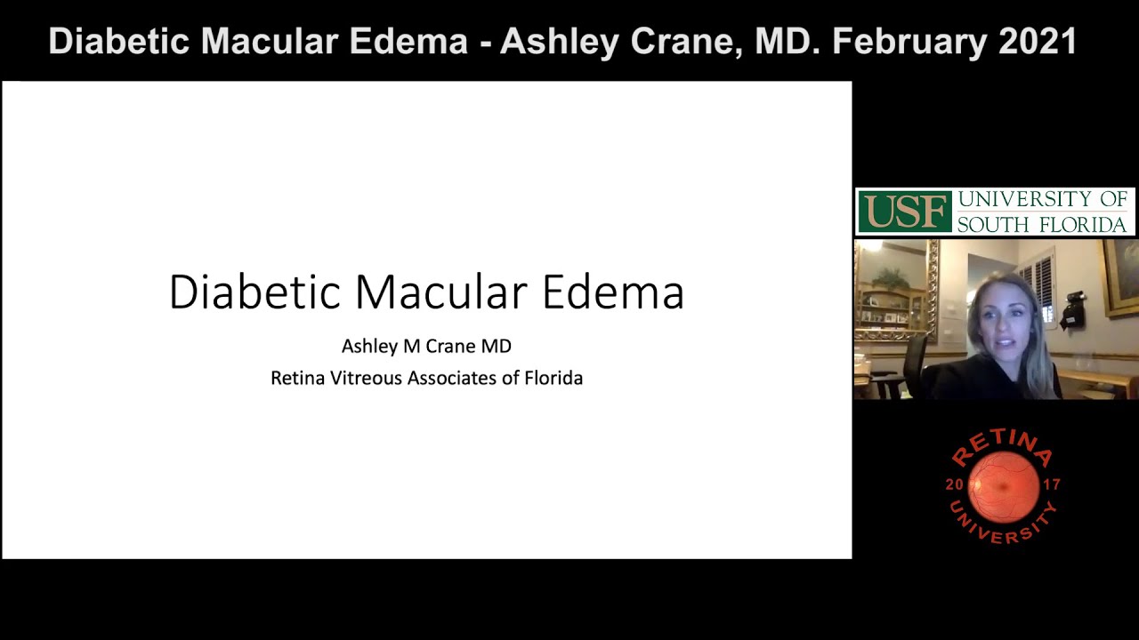 Diabetic Macular Edema - Evaluation and Management