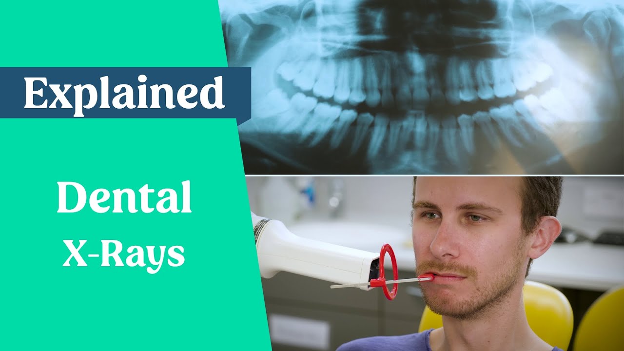 Dental X-Rays Explained