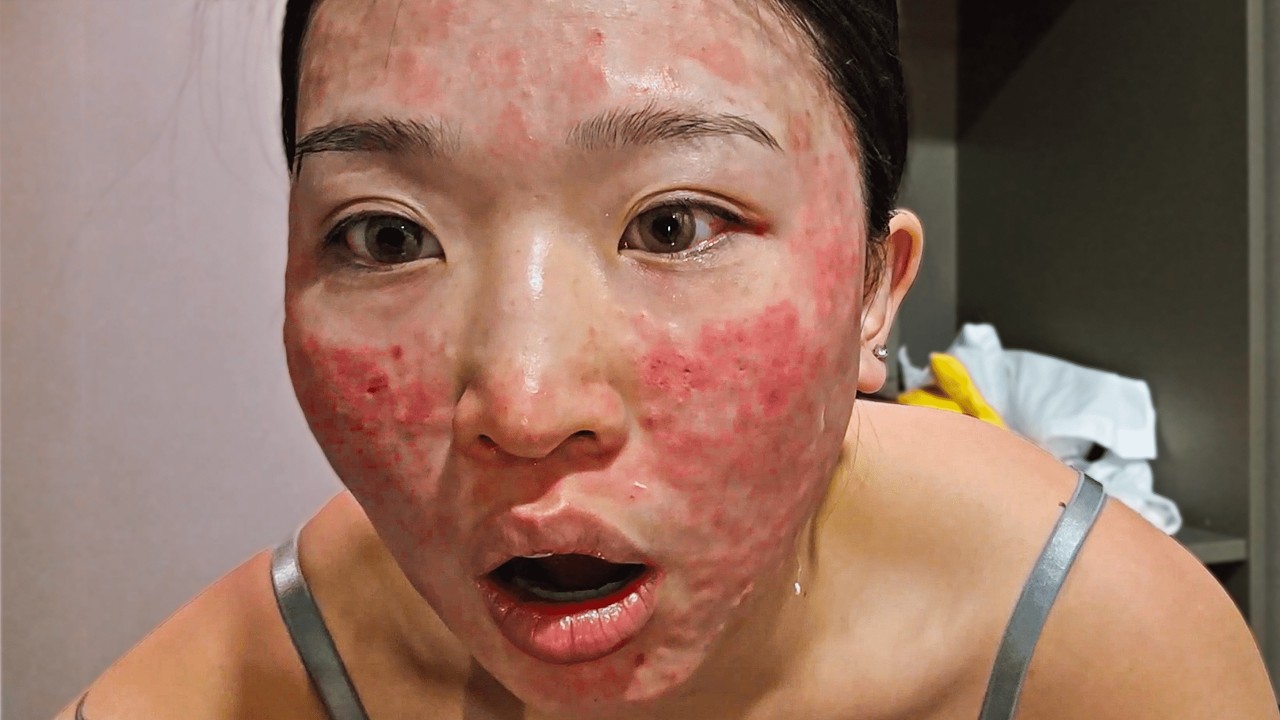 I Tried Korea's $10,000 Skincare Procedure *PAINFUL*