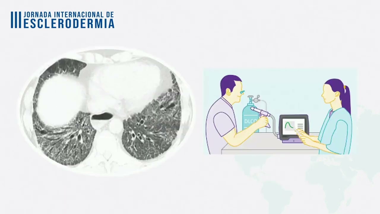 Enfermedad Pulmonar Intersticial en Esclerodermia