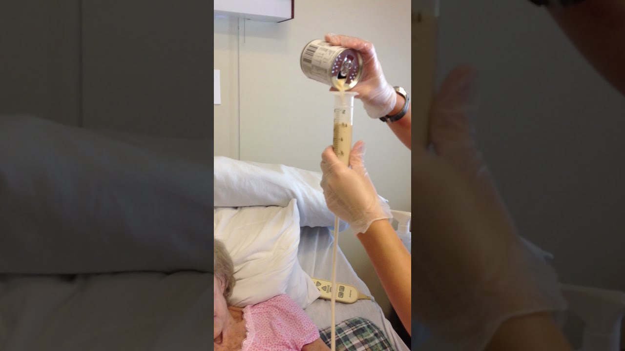 How to Do a Tube Feeding (Bolus method)