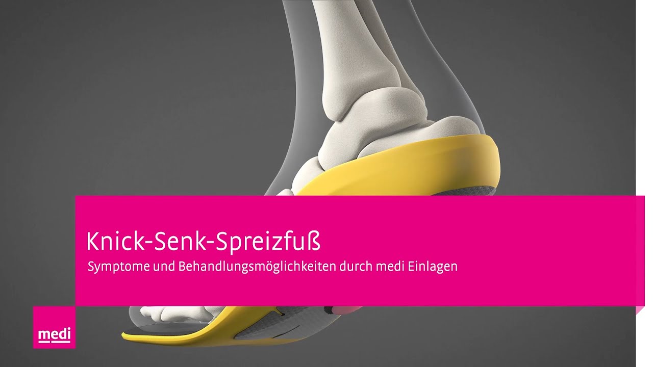 Plattfuß – Knick-Senk-Spreizfuß: Behandlung mit orthopädischen Einlagen aus Carbon von medi