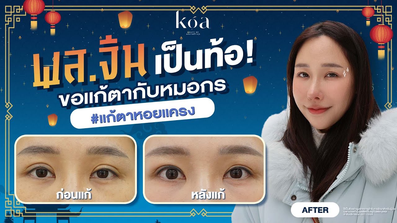 แก้ตาหอยแครง ชั้นตาหนา-ตาโตเกิน แก้เป็นลุคธรรมชาติหลบใน | KOA clinic
