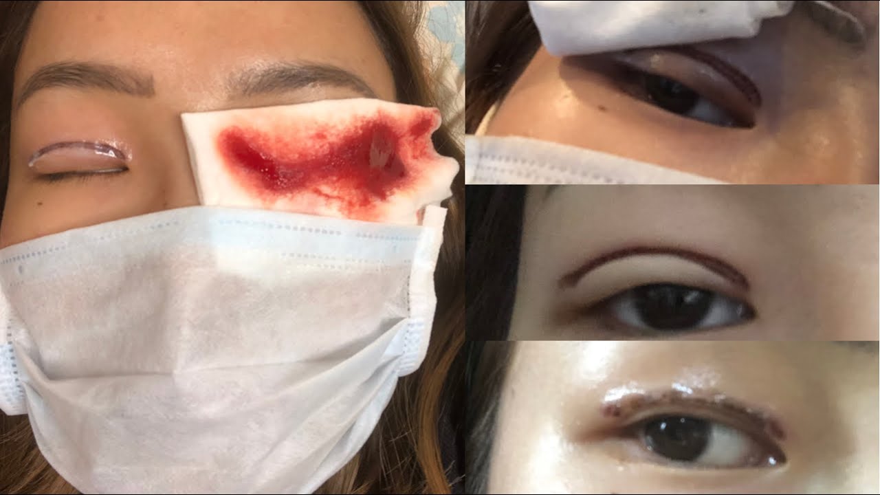 Non Surgical Double Eyelid Treatment Plasma Mizoram (Honest Review & My Experience)