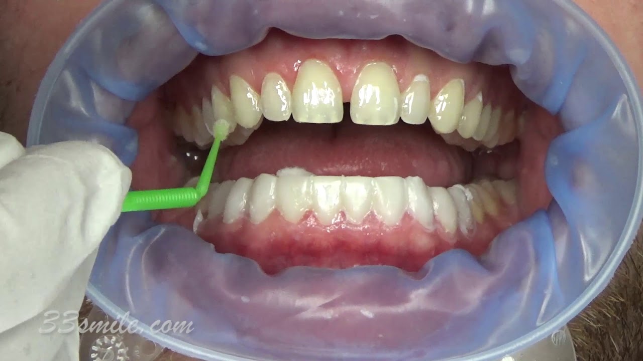 Upper and Lower Prepless Veneers 33Smile San Antonio Cosmetic Dentistry