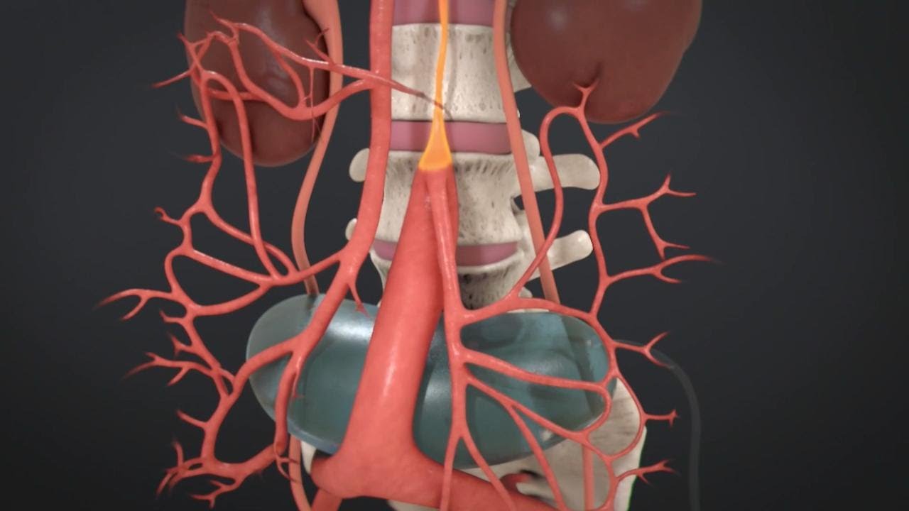 How we treat Midaortic Syndrome - TESLA Procedure | Boston Children's Hospital