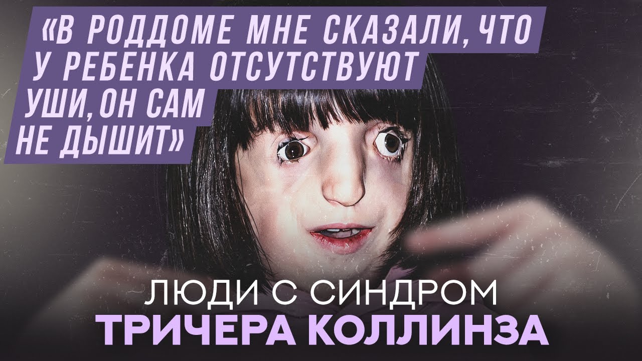 Люди с синдромом Тричера Коллинза | Хочу спросить