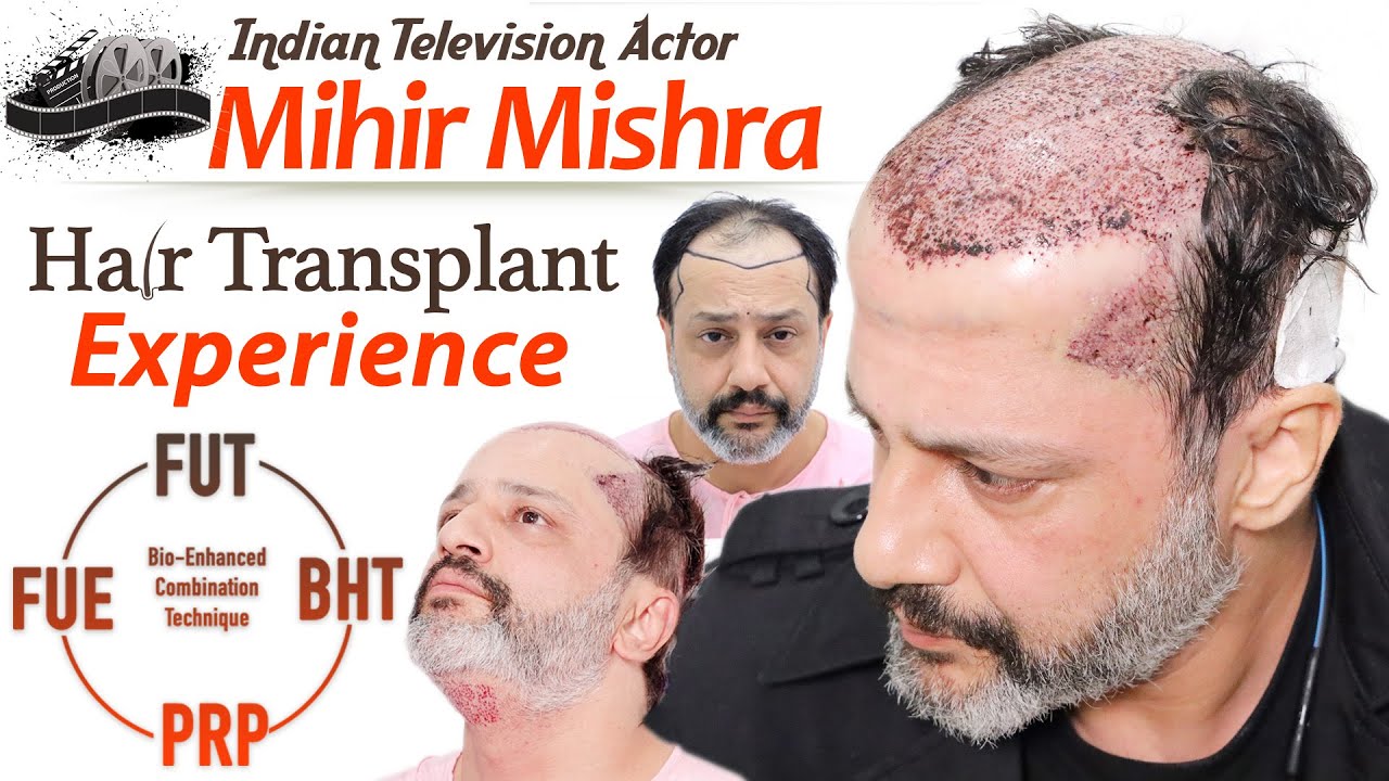 Celeb Hair Transplant in India | ACTOR MIHIR Mishra Surgery | MEDISPA India | Dr. Suneet Soni |India